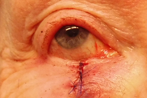 hechten van de wond na mohs chirurgie voor basaalcelcarcinoom van het ooglid